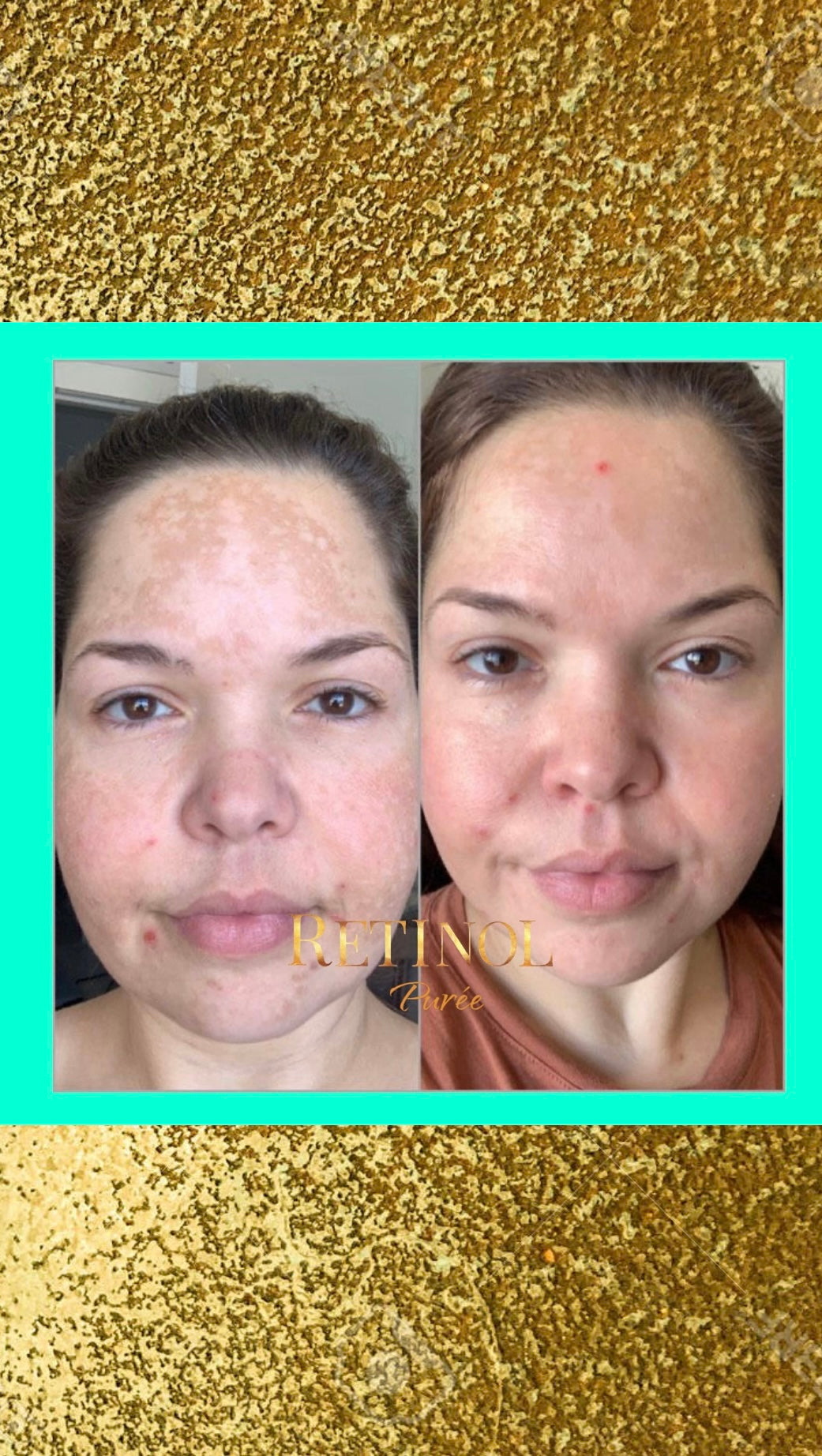 RETINOL+ HIDROQUINONA2% Vitamina E,B5 es una solución efectiva que Combate MANCHAS/ e hiperpigmentación
