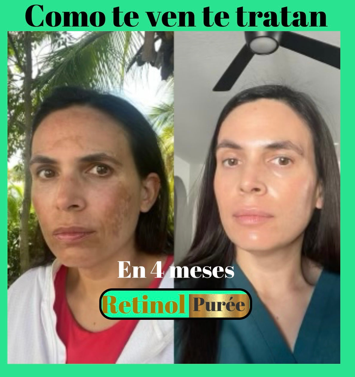 RETINOL+ HIDROQUINONA2% Vitamina E,B5 es una solución efectiva que Combate MANCHAS/ e hiperpigmentación