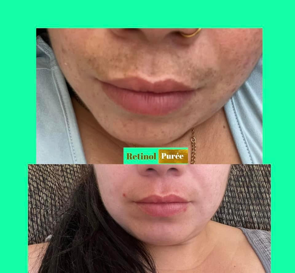 RETINOL+ HIDROQUINONA2% Vitamina E,B5 es una solución efectiva que Combate MANCHAS/ e hiperpigmentación
