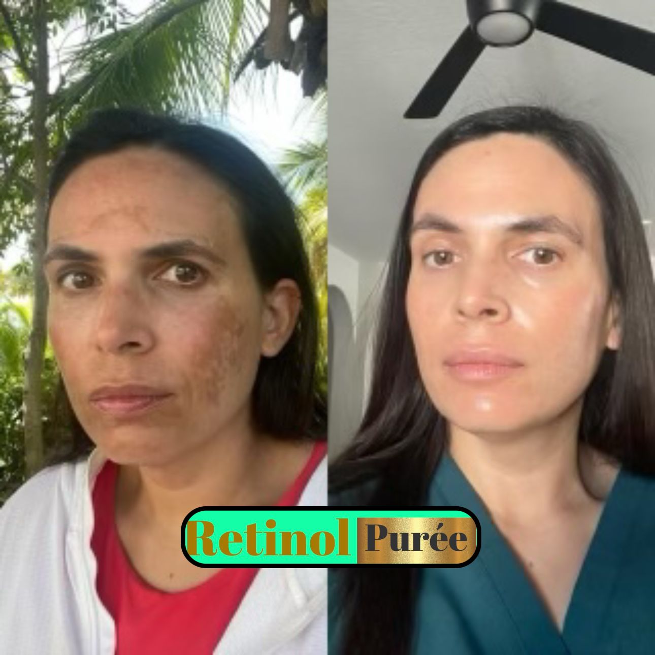 Despigmentante, RETINOL Y HIDROQUINONA 2%, B5 ✅ Combate manchas, MELASMA, ACLARA RÁPIDO Y EFECTIVAMENTE