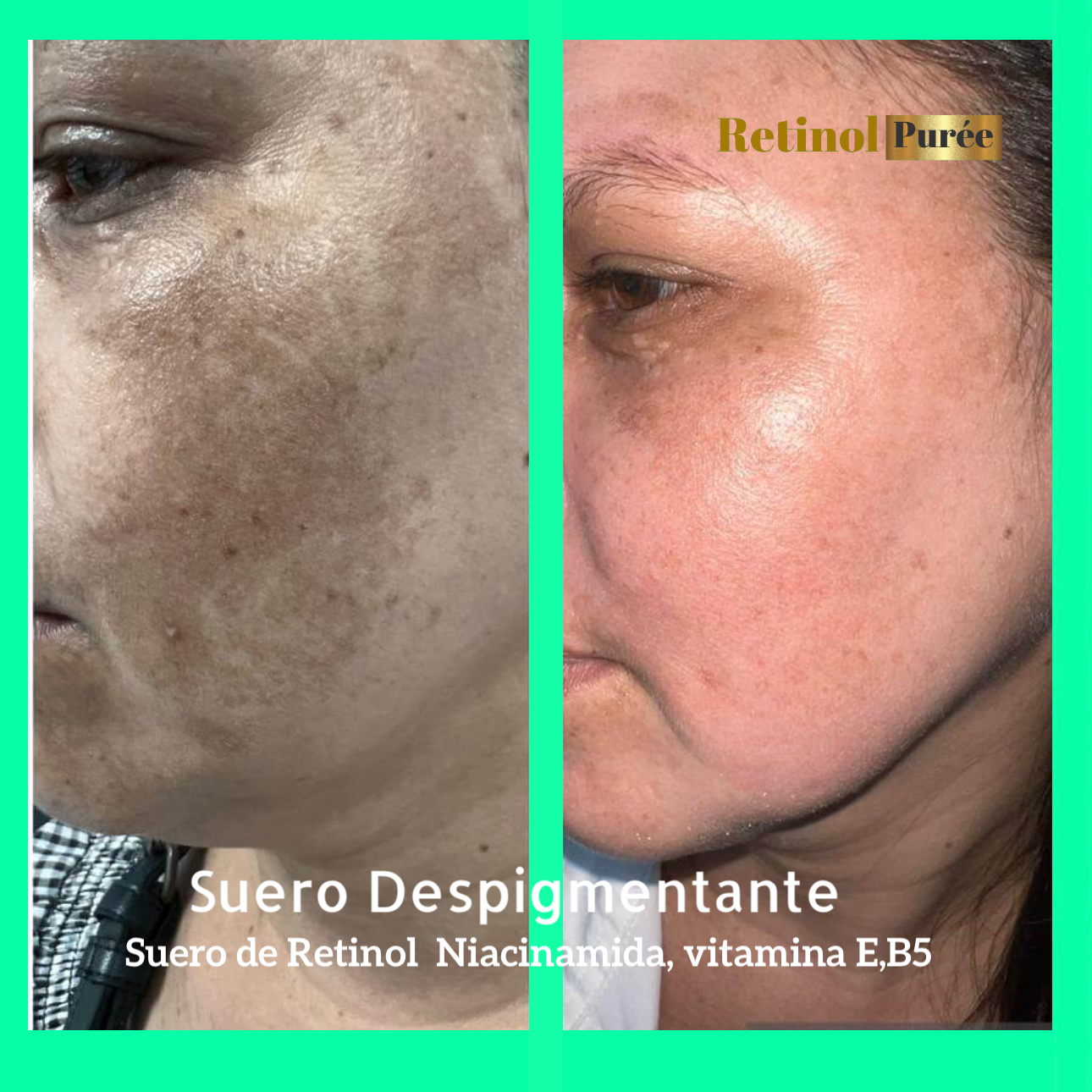 Despigmentante, RETINOL Y HIDROQUINONA 2%, B5 ✅ Combate manchas, MELASMA, ACLARA RÁPIDO Y EFECTIVAMENTE